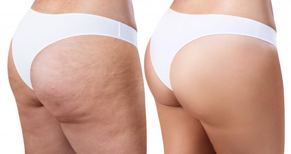 Smooth Cellulite Fast – Deep Suction & Heat for Visible Results