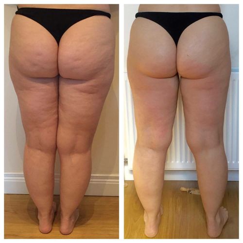 Smooth Cellulite Fast – Deep Suction & Heat for Visible Results