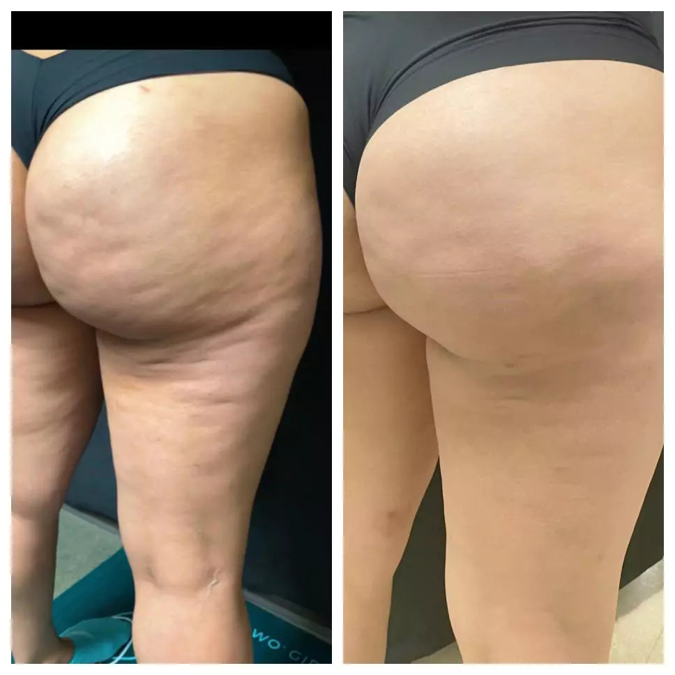 Smooth Cellulite Fast – Deep Suction & Heat for Visible Results