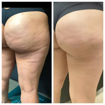 Smooth Cellulite Fast – Deep Suction & Heat for Visible Results