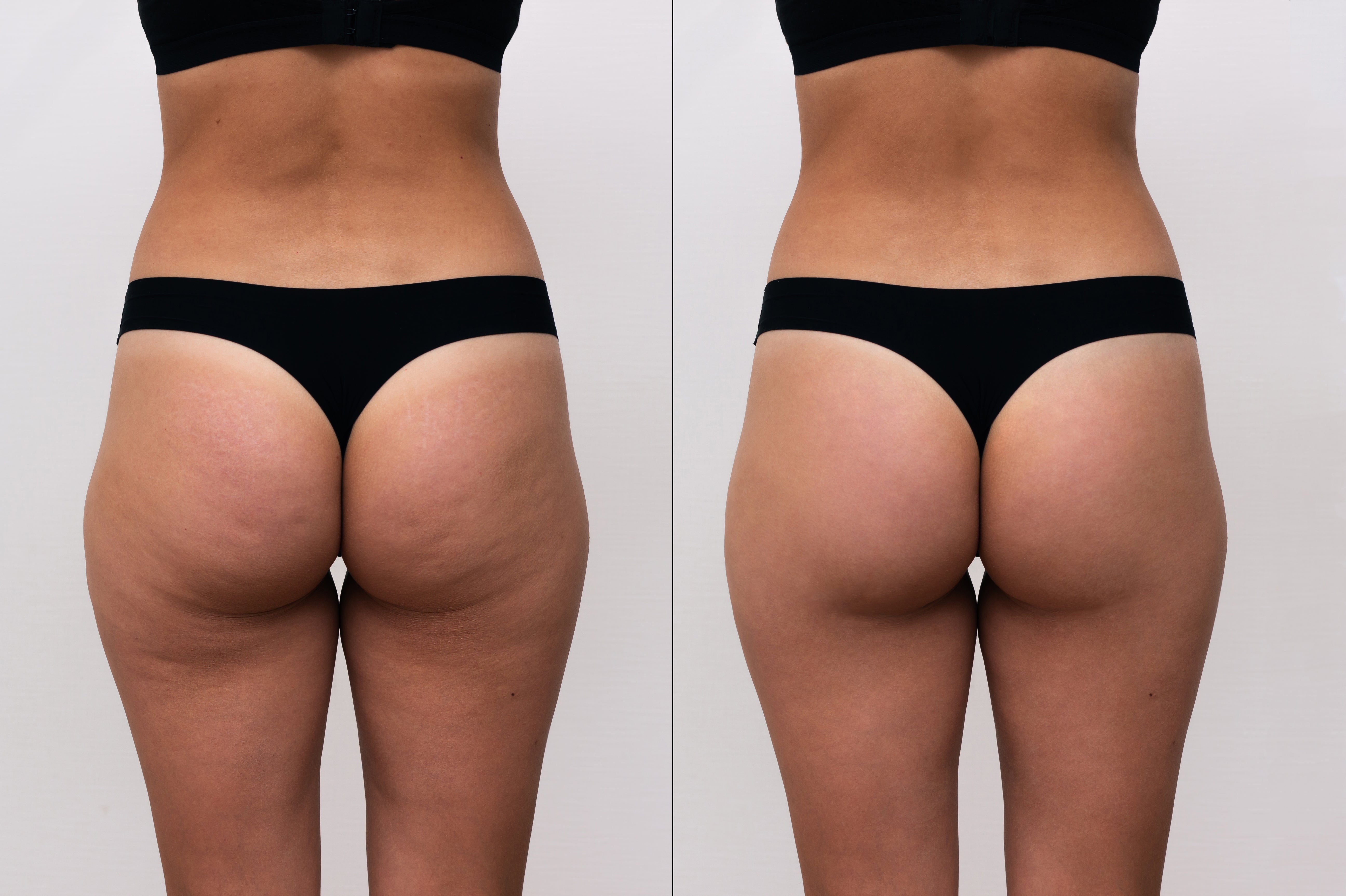 Smooth Cellulite Fast – Deep Suction & Heat for Visible Results